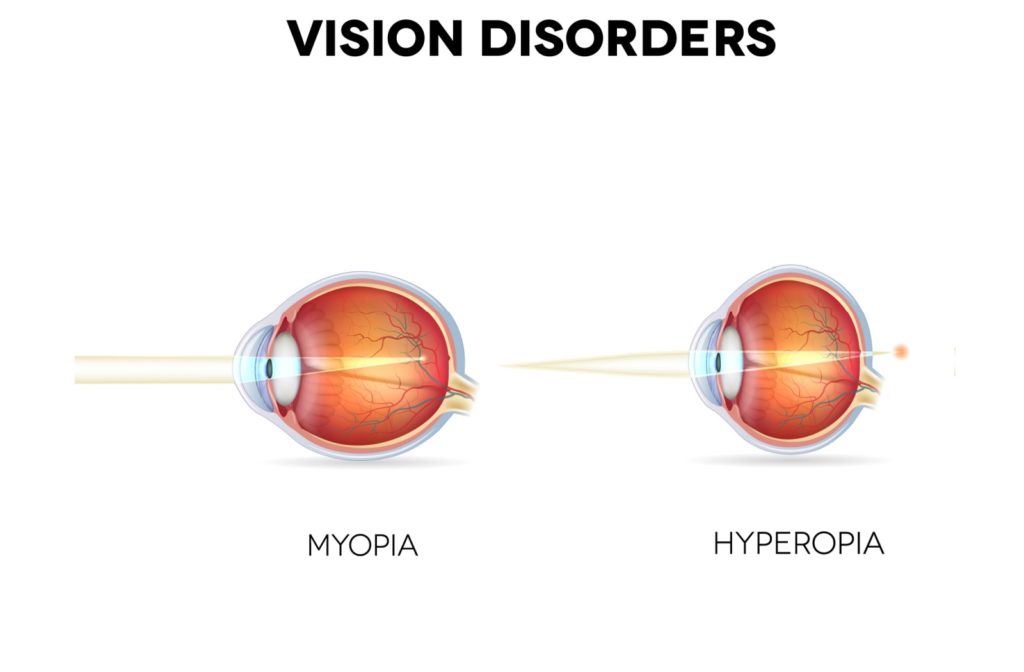 A pictorial representation of how myopia and hyperopia vision disorders work.