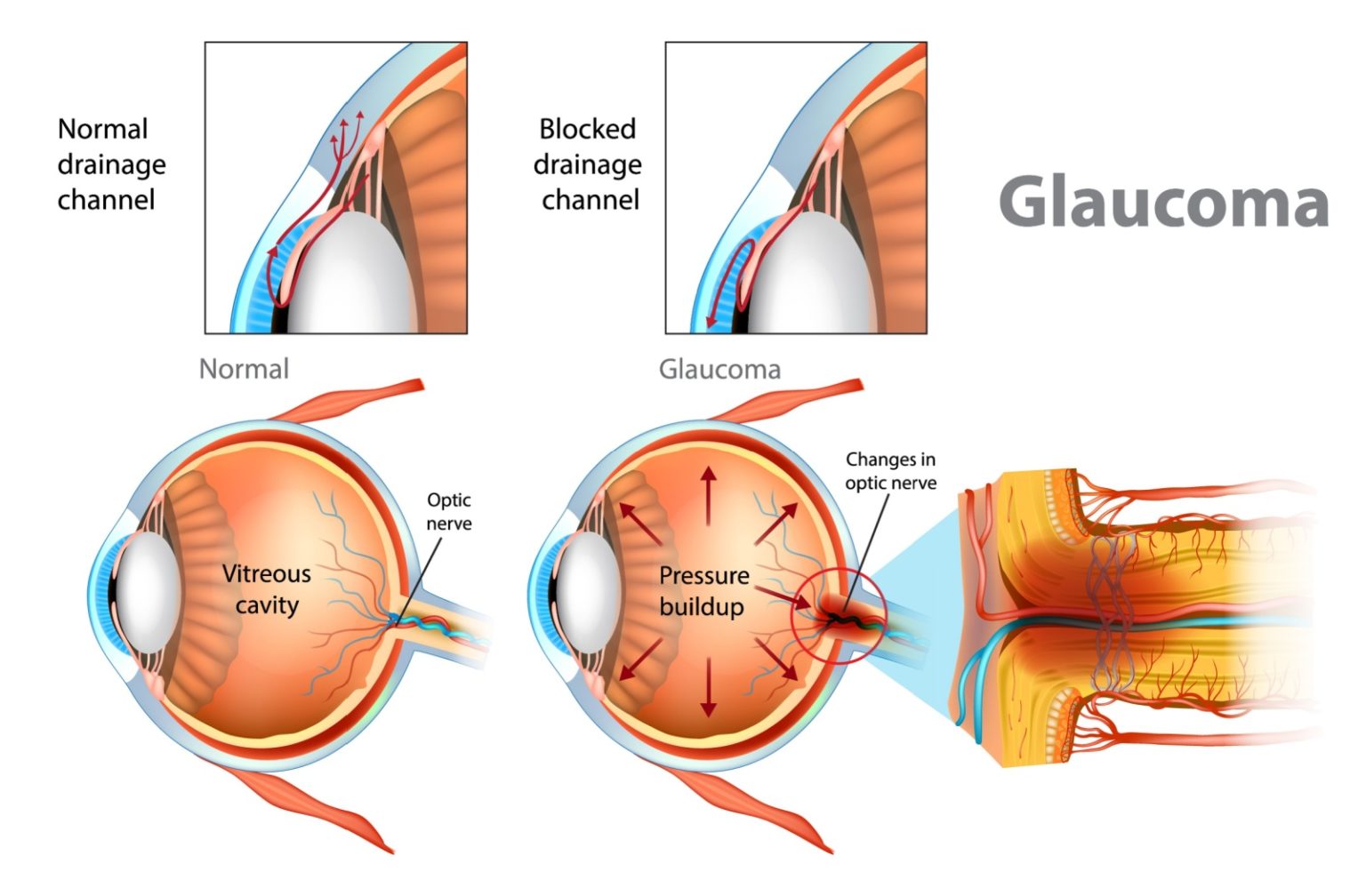 Are Glaucoma And Macular Degeneration The Same Are Glaucoma And Macular Degeneration The Same