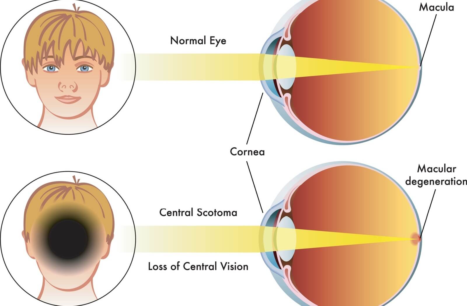 A graphic illustrates the difference in central vision between a normal eye and one with macular degeneration.